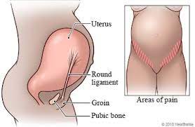 Is it Lightning Crotch, Round Ligament Pain, or Pubic Symphysis  Dysfunction? - OrthoPelvicPT